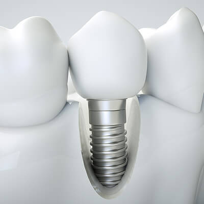 Dental Implants