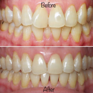 Before and after photo of teeth with braces 