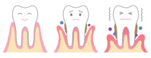 Pictures of Periodontal Disease