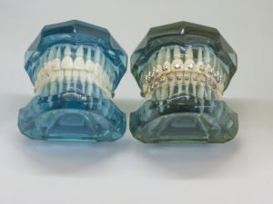 Image of teeth with braces