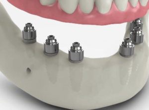 Full Arch Dental Implant 