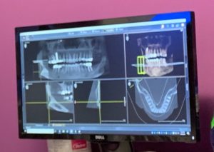 Dental Implants X-Ray 