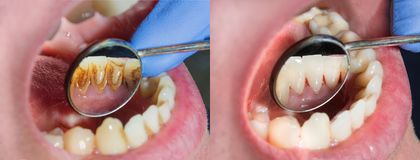 before and after of person with plaque in their teeth 