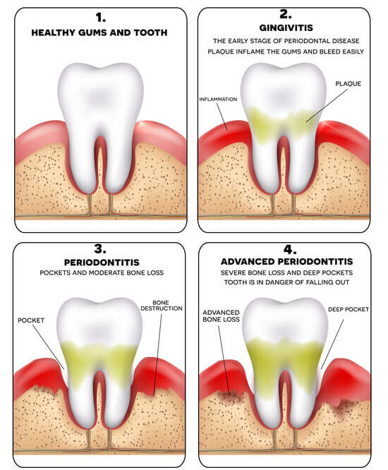 diagram of periodontitis